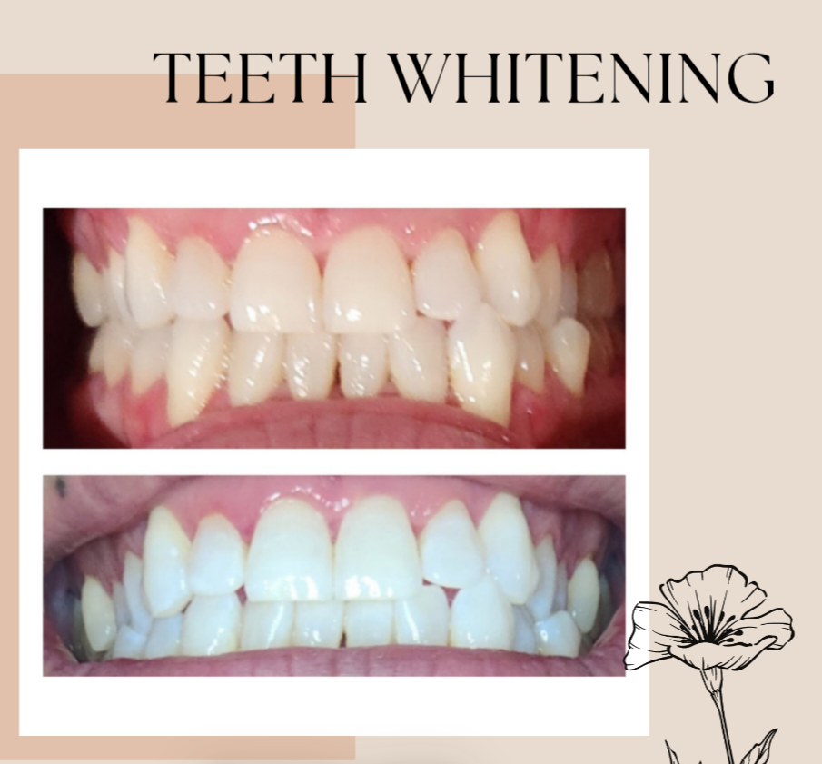 Teeth Whitening