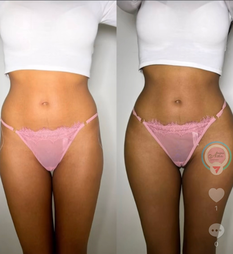 BBL ENHANCEMENT (300ML)