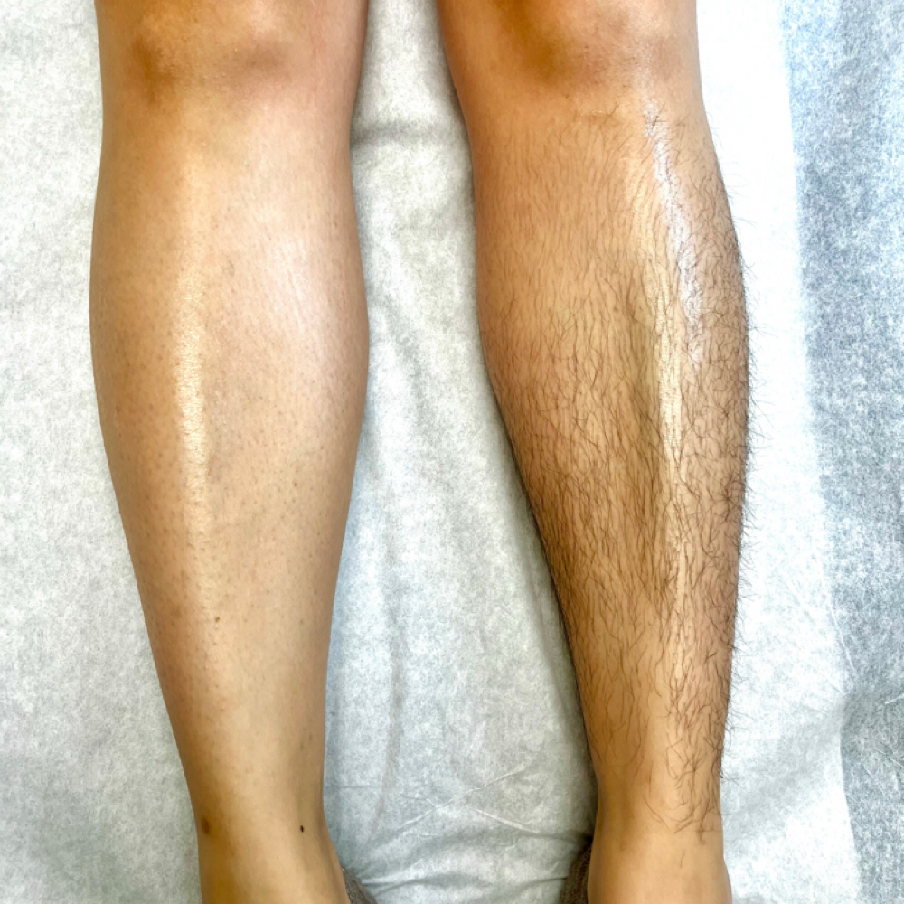 Half Leg at EttaJDerma Esthetics and Spa in Dallas, TX