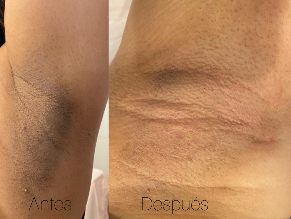 Peeling en las axilas