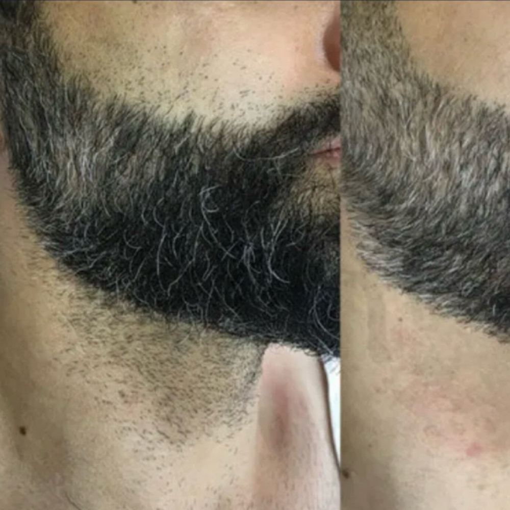 Beard & Neck Laser - 5 Sessions at Blessed & Bare Laser Studio in New York, NY