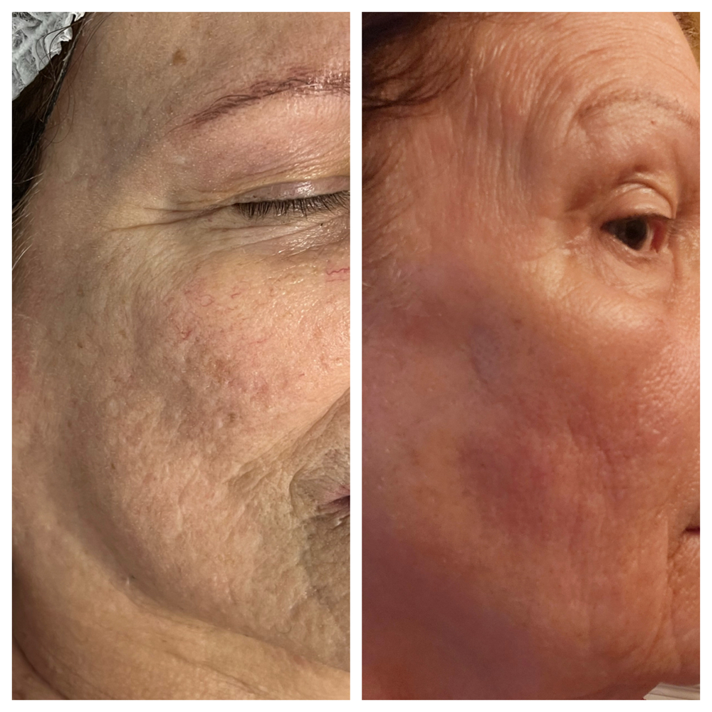 Acne Gone Skin Resurfacing Laser