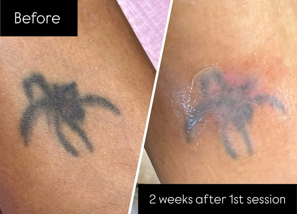 Magnetic Tattoo Removal