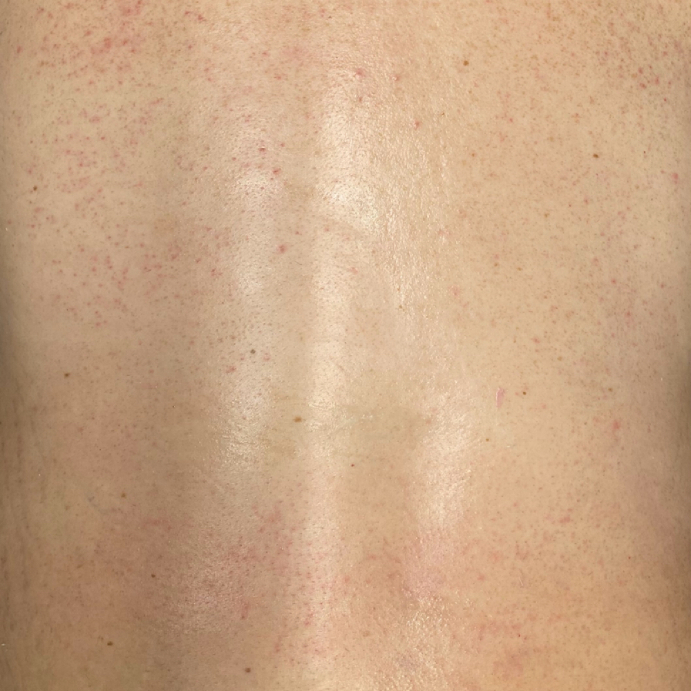 Back Wax at Crystal Clear Skin by Madison in Sherman, TX