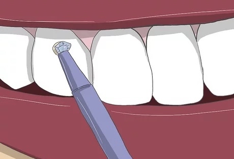 Tooth Gem Removal Per Gem