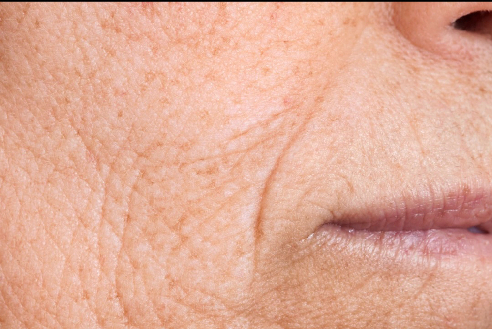 Wrinkle Tightening Treatment