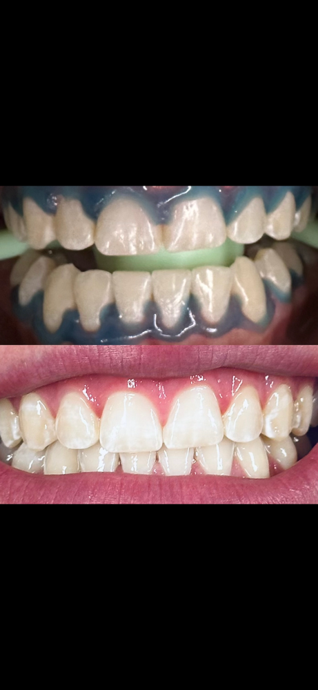 Teeth Whitening