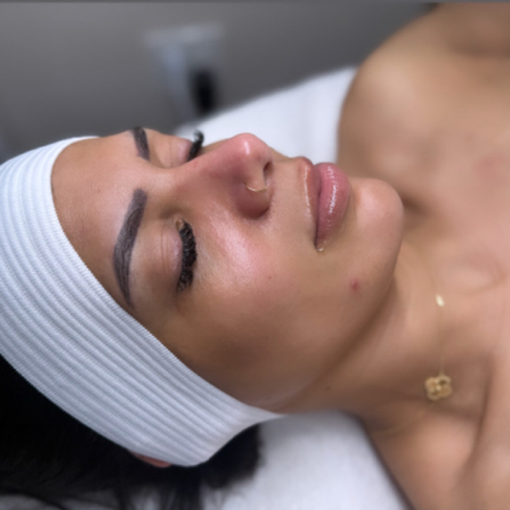 Chemical Peel Revitalize at Marta Rabelo Skin & Laser in Malden, MA