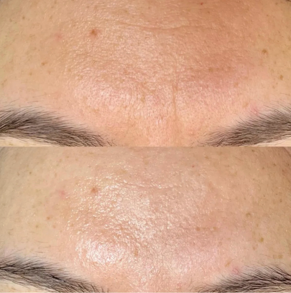 Better Than Botox (V Tox + Carboxy) at The Full Edit Aesthetic Studio in Florence, AL