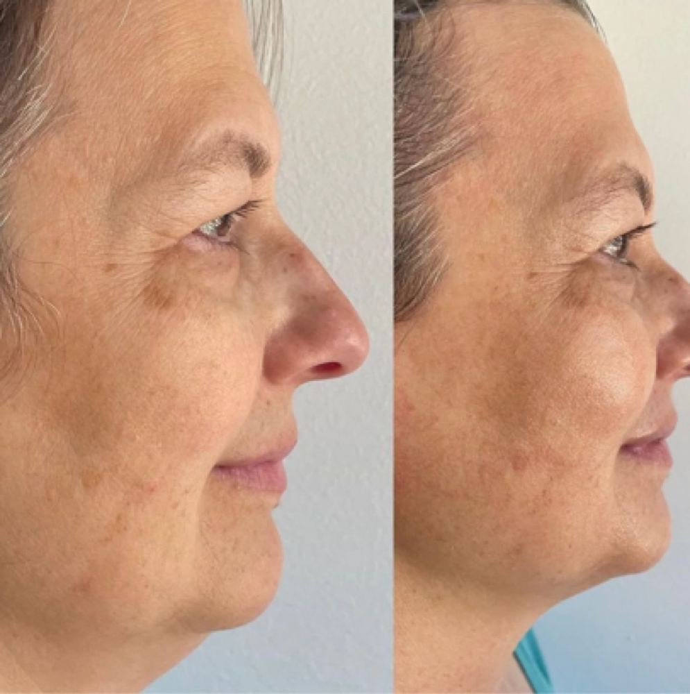 The Natural Facelift (KrX V Tox)