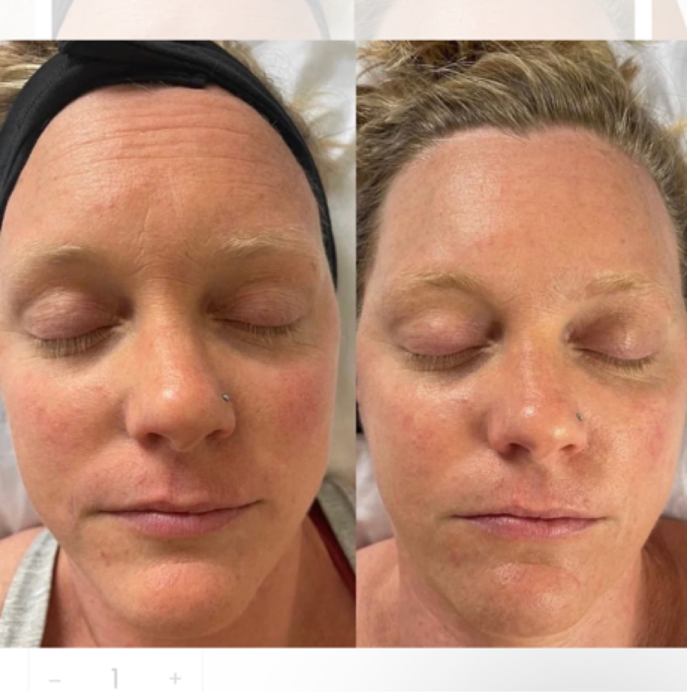 Better Than Botox (V Tox + Carboxy) at The Full Edit Aesthetic Studio in Florence, AL