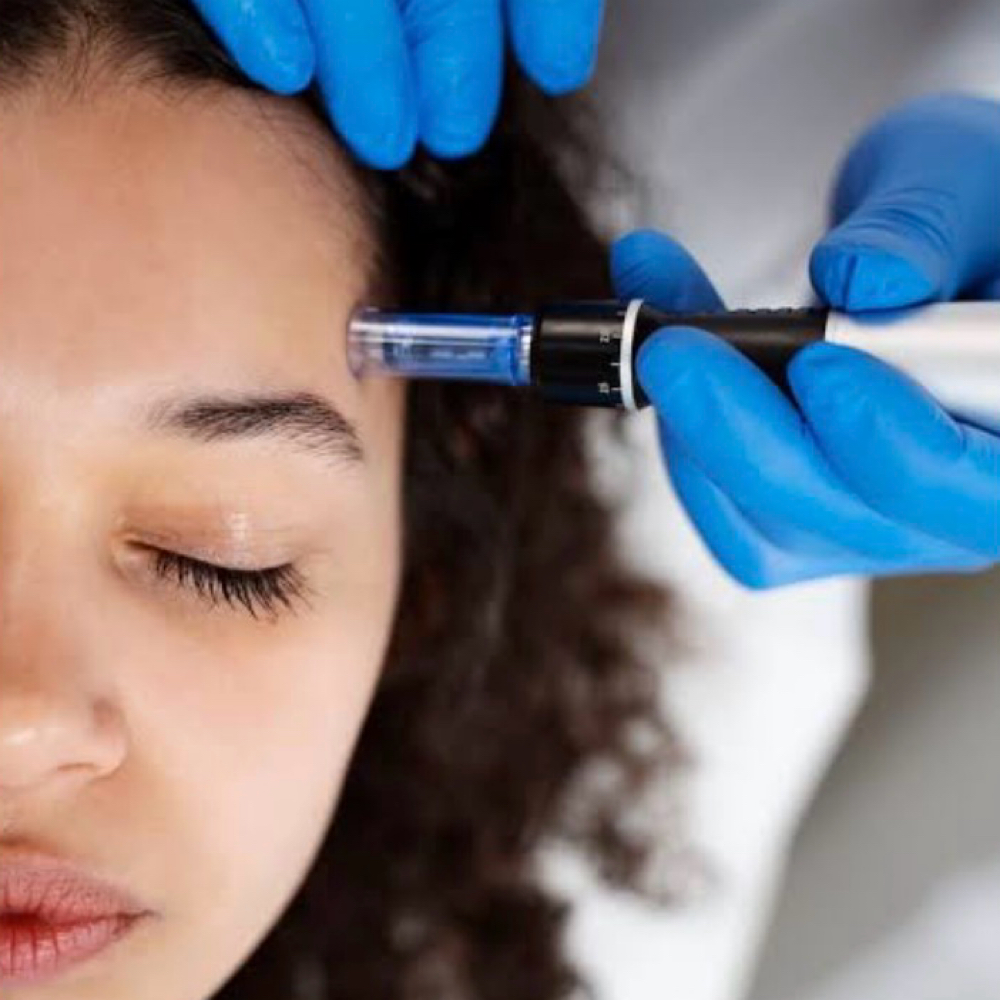 Microneedling Facial at Vibe Skin Lab in Woburn, MA