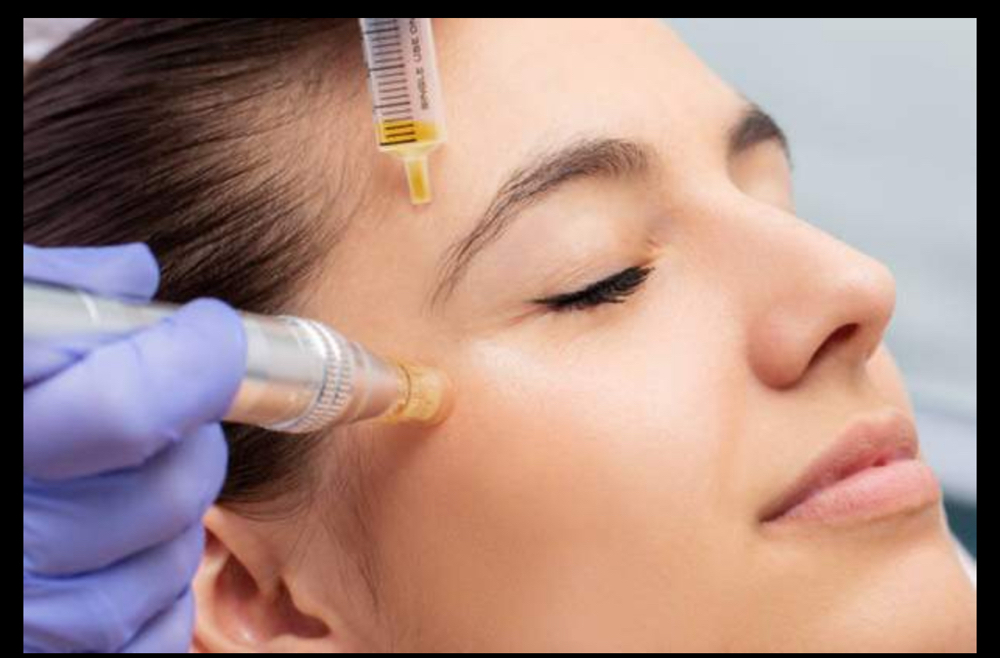 Microneedling