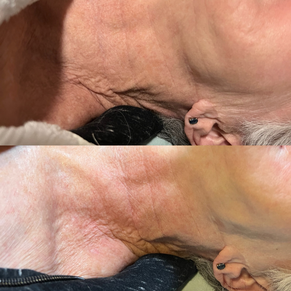 Body Scuplting 9 Session Deal