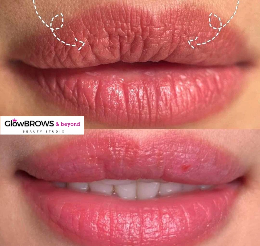 LIPs rejuvenate by Plasma