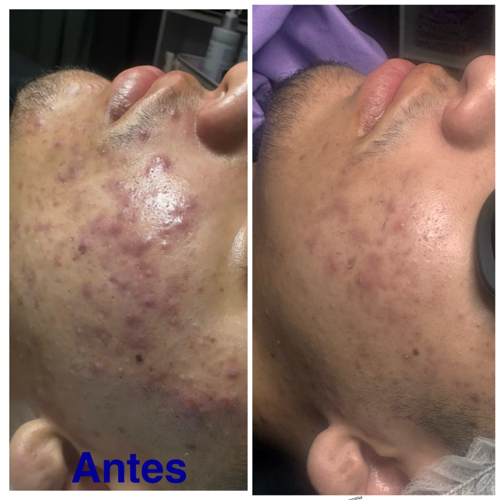 ACNE FACIAL at Dolls skin in Waukegan, IL
