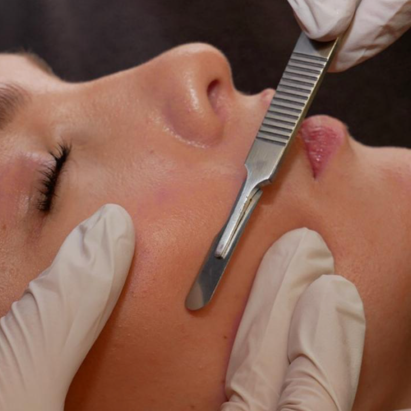 Dermaplaning