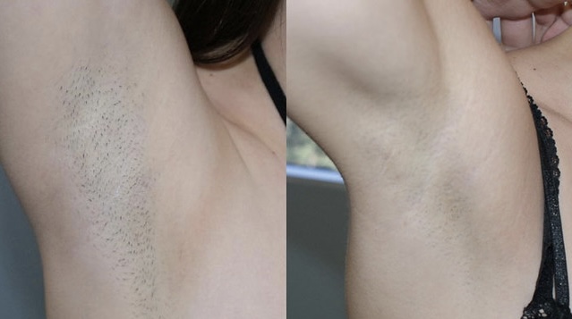 Ingrown/Pigmentation Treatmnt AddOn