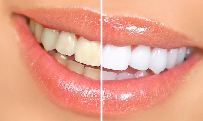 Teeth Whitening 1Hour +