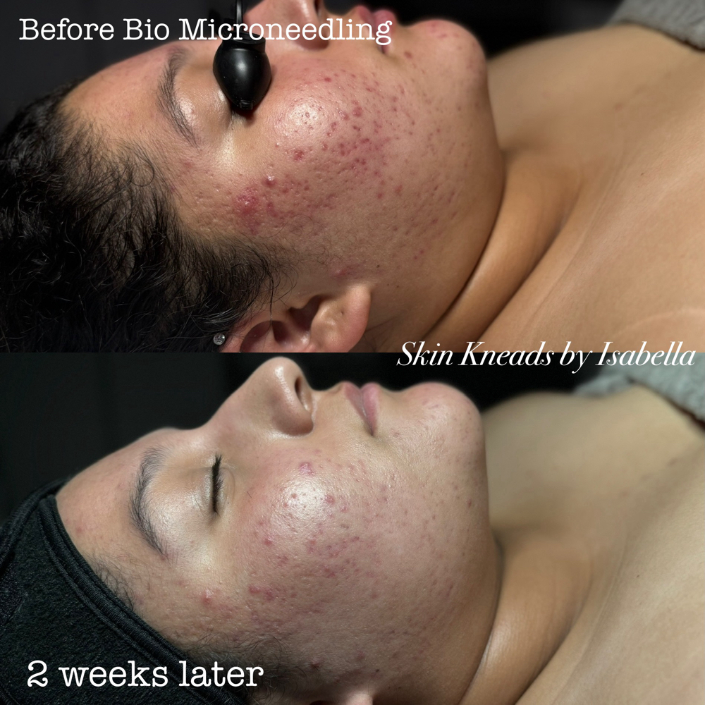 Bio Microneedling