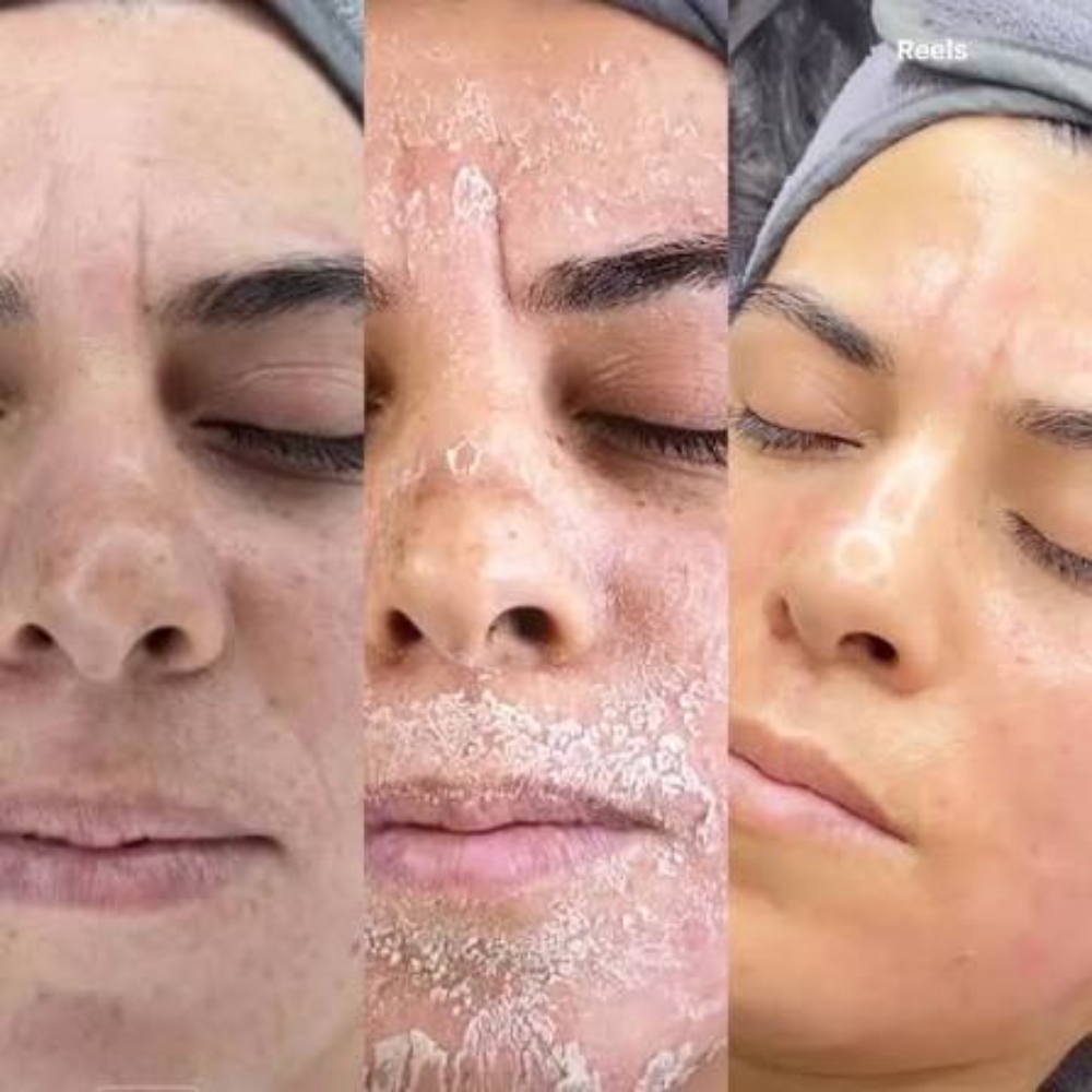Package - Peel Series at LexGlo Esthetics in Idaho Falls, ID