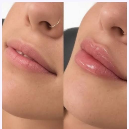 Lip Filler at Ultimate Health Spa in Leesburg, FL