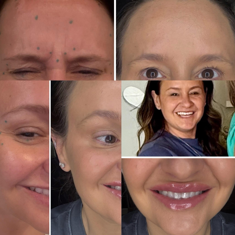 DYSPORT at Candice Stacy in Gilbert, WV