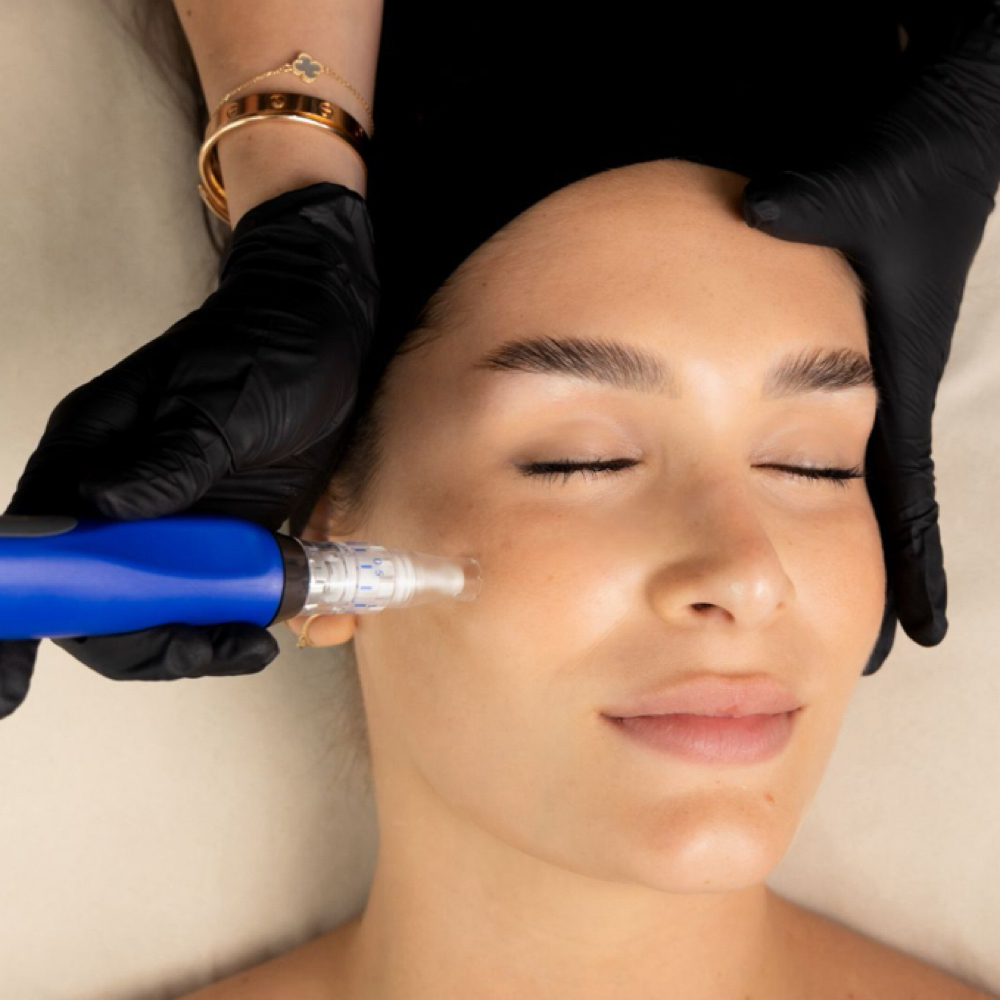 MICRONEEDLING (ADD ON) at BEAUTY LAB COLLECTIVE in Miami, FL