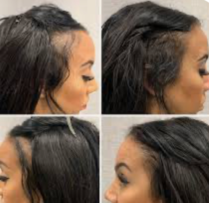 Scalp Micro-Pigmentation