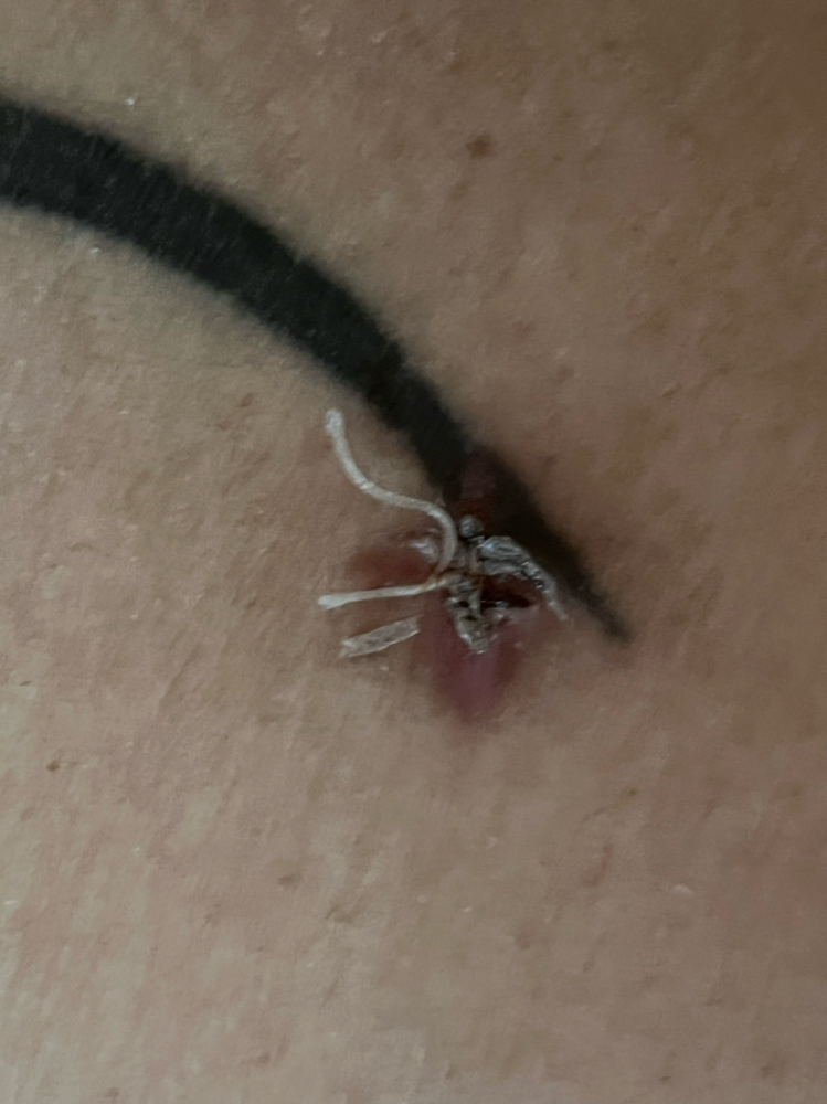 Suture Removal