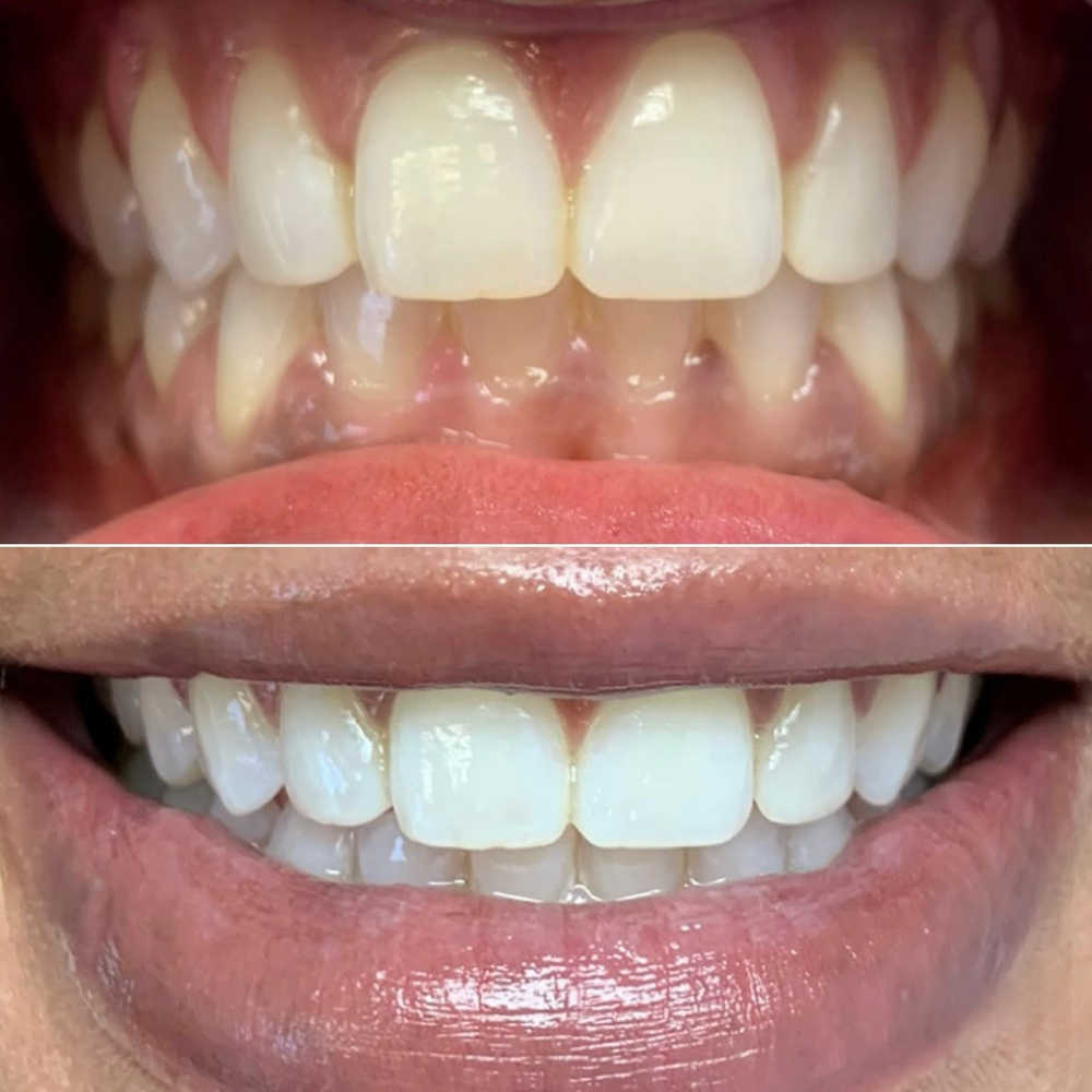 $50 Teeth Whitening Special at COSMIC 8 in Houston, TX