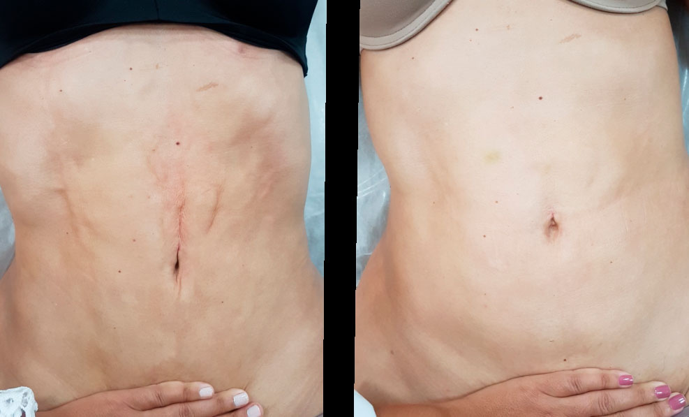 Fibrosis Treatment (Post Surgery)