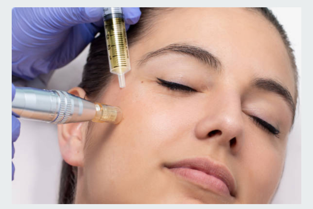 Microneedling with PRP