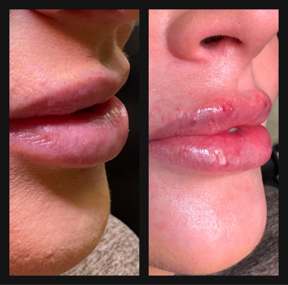 Lip Filler Full Syringe (1 mL)