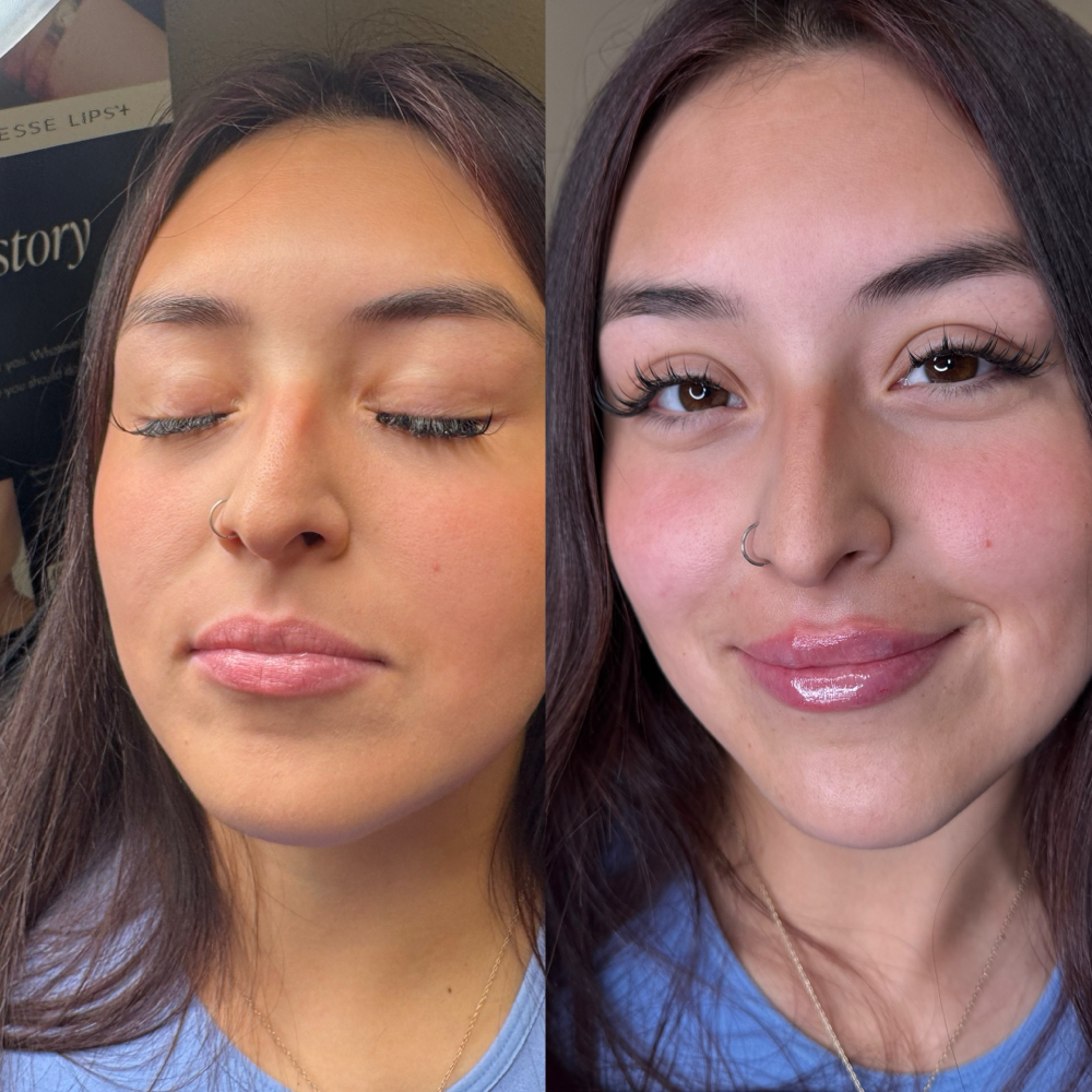 Lip Filler Full Syringe (1 mL) at Dvash Aesthetics in Lubbock, TX