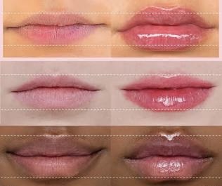 Meso Lip Plump
