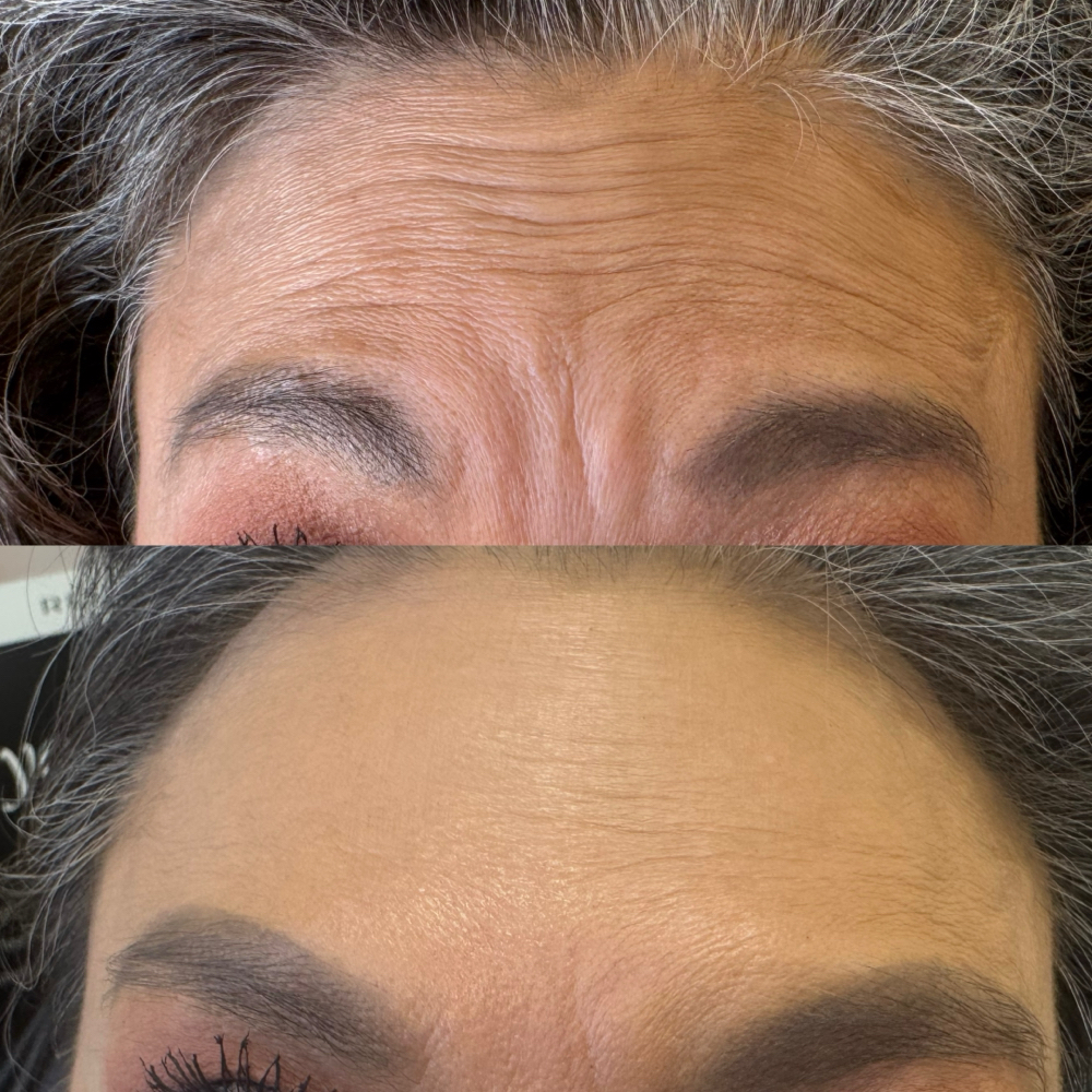Botox $12/unit at Dvash Aesthetics in Lubbock, TX