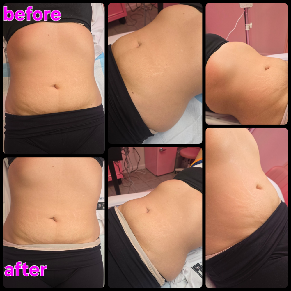 RF Body Sculpting And Cavitation