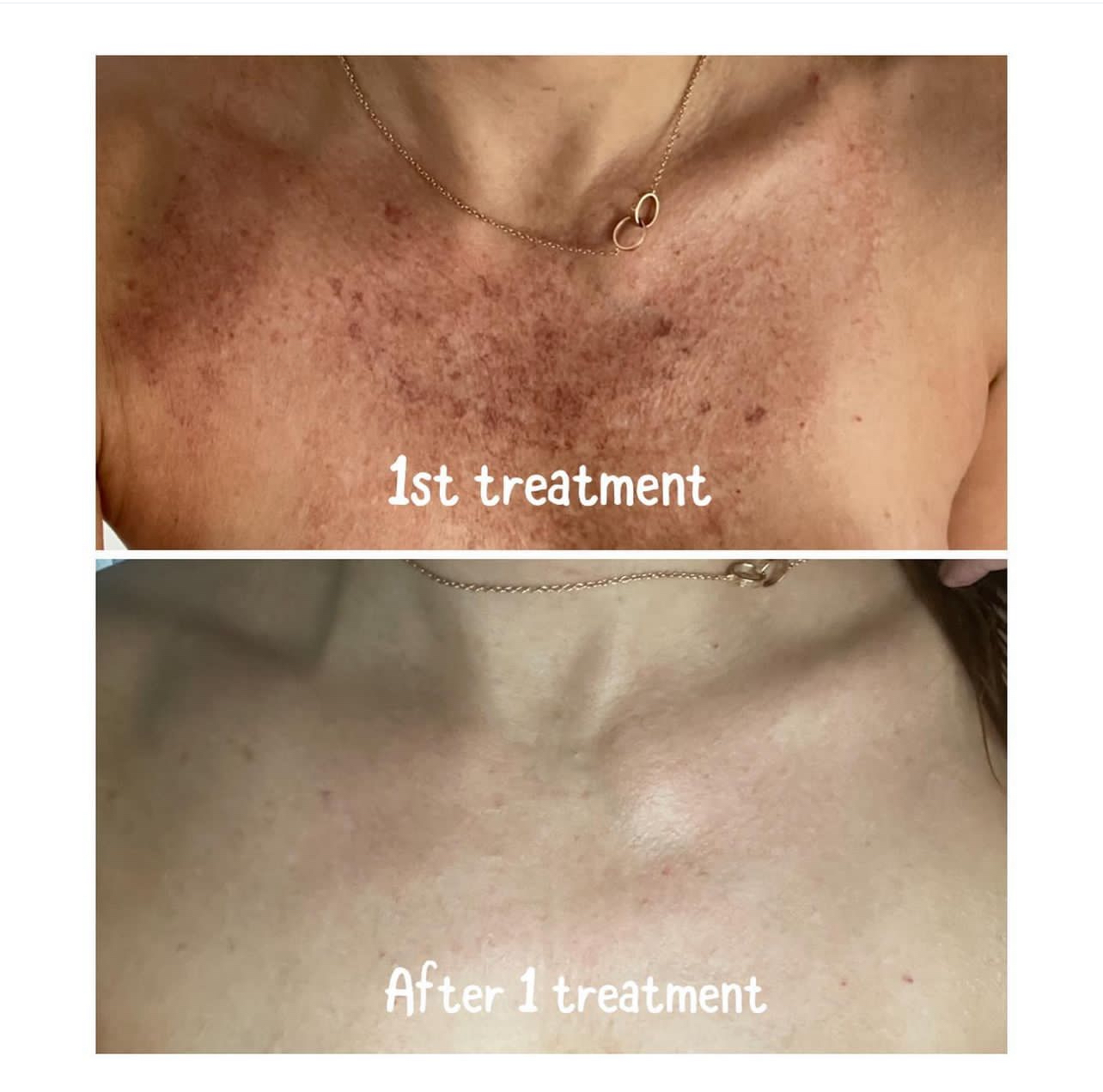IPL Hyper-Pigmentation Laser at Magnifique Laser Spa in Rockville Centre, NY