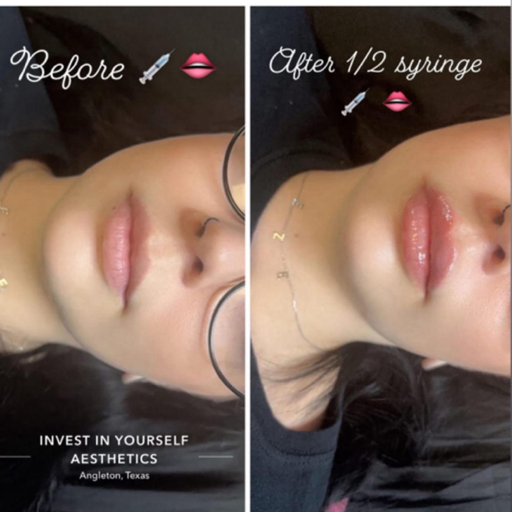 Lip Filler(Half) at Abigail Espinoza in Angleton, TX