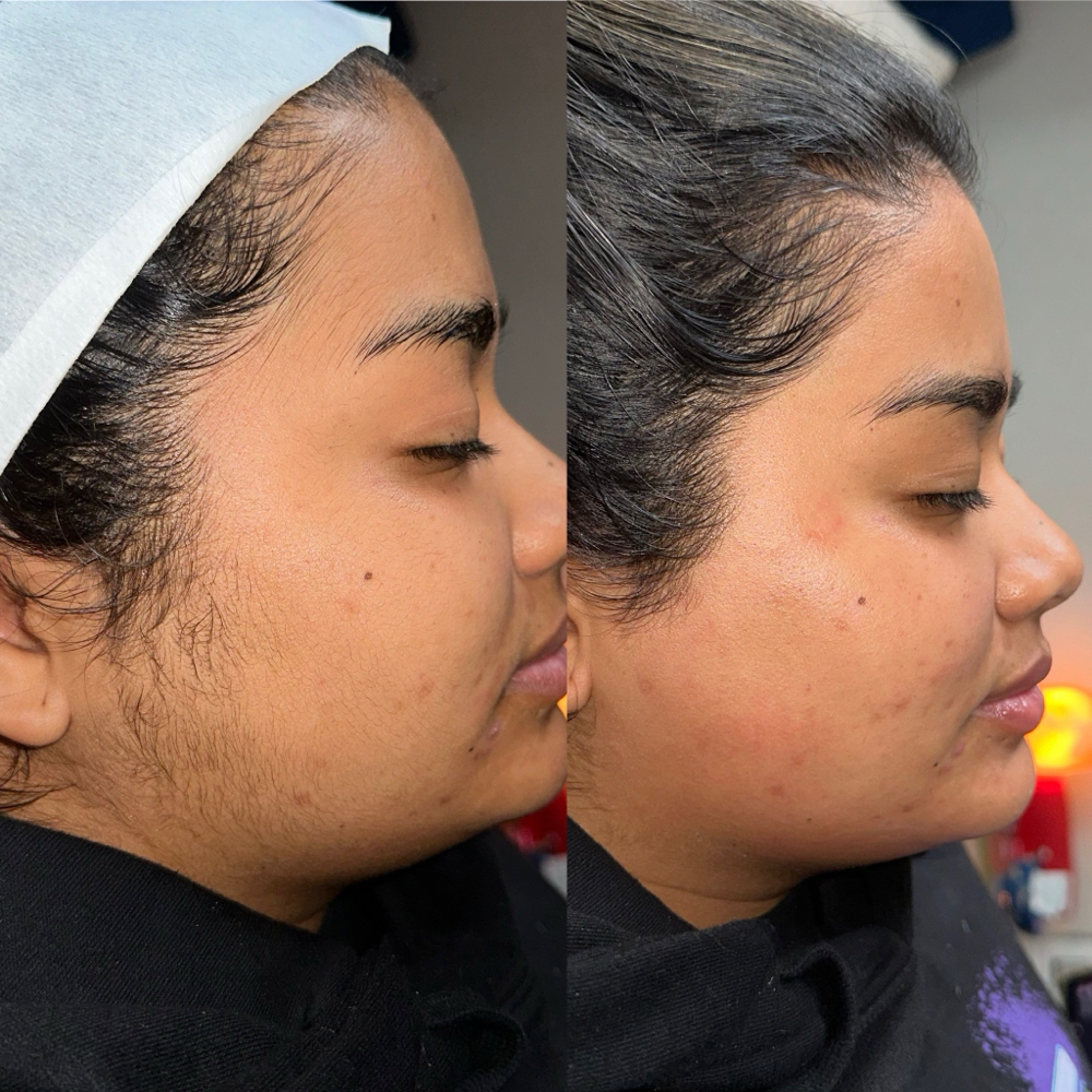 Dermaplane Glow Facial