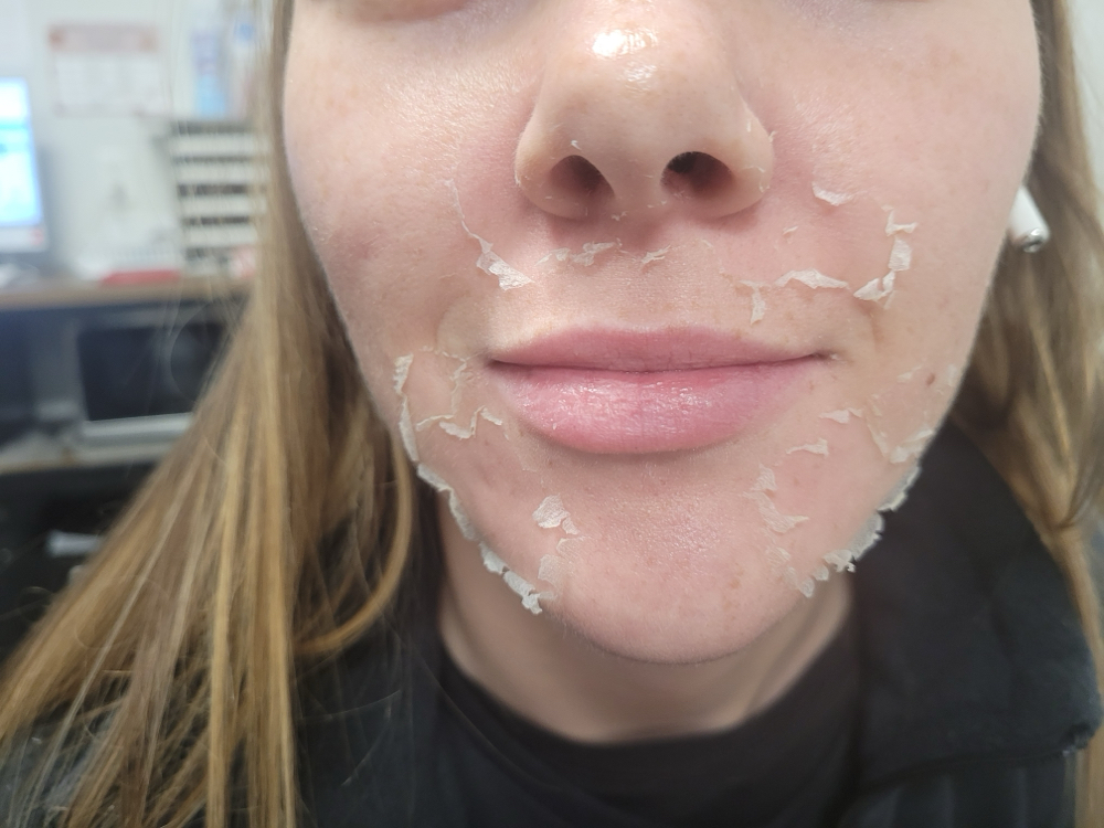 Advanced Glow Chemical Peel