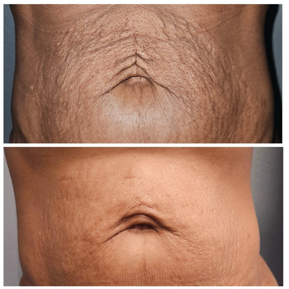 Tightening Affect: Abdomen at Ever Glow Paramedical Beauty Lounge in Lubbock, TX