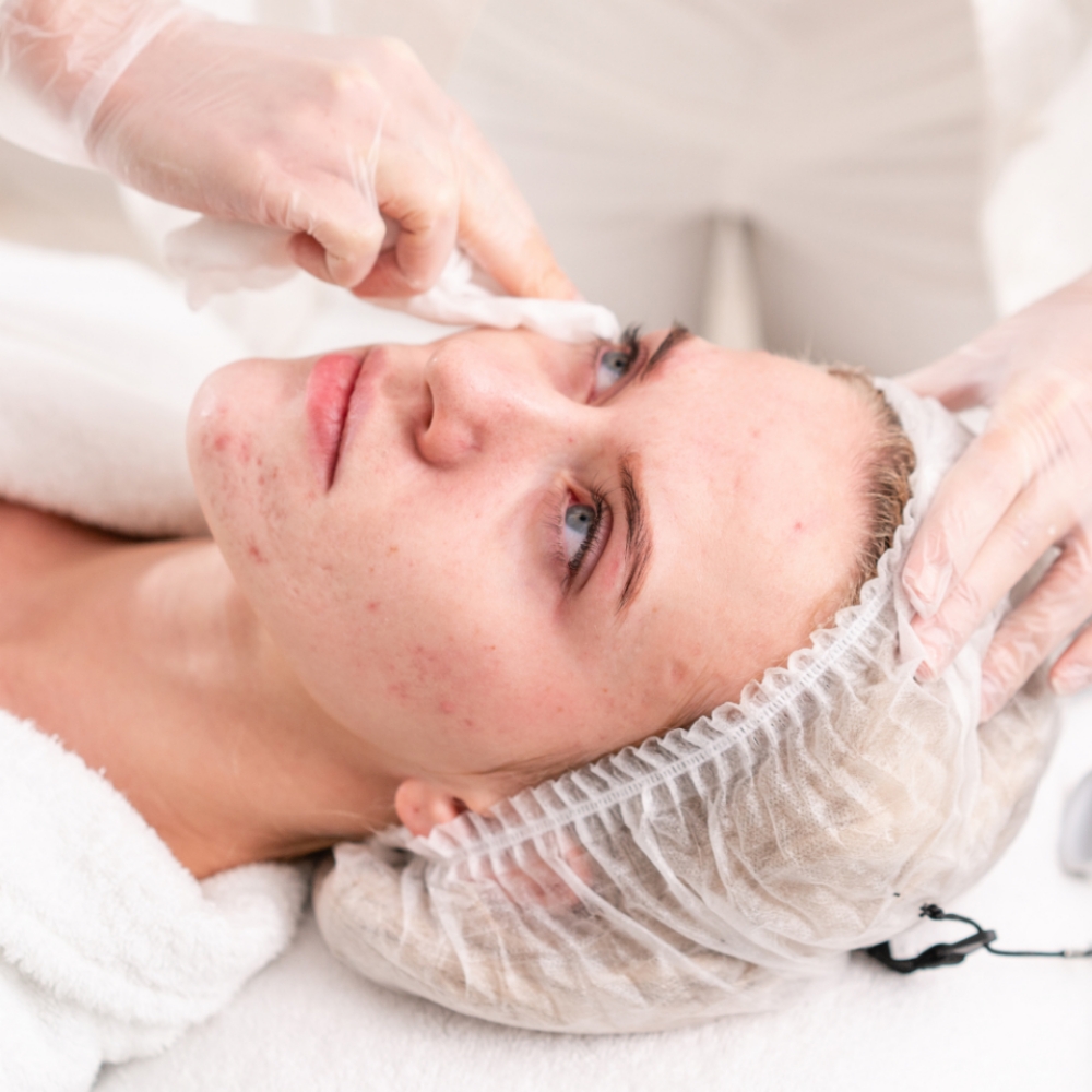 Acne Bootcamp Consultation And Tx at R&R Skin and Lash Studio in Sparta, NJ