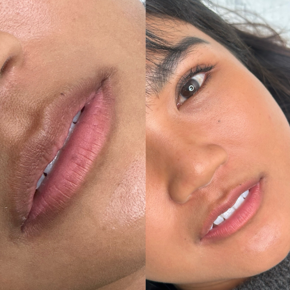 Dark Lip Neutralization