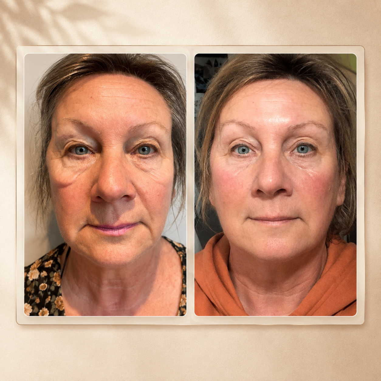 Anti-Aging RF Rejuvenation at Tiffany - Sculpted Beauty in Nettleton, MS