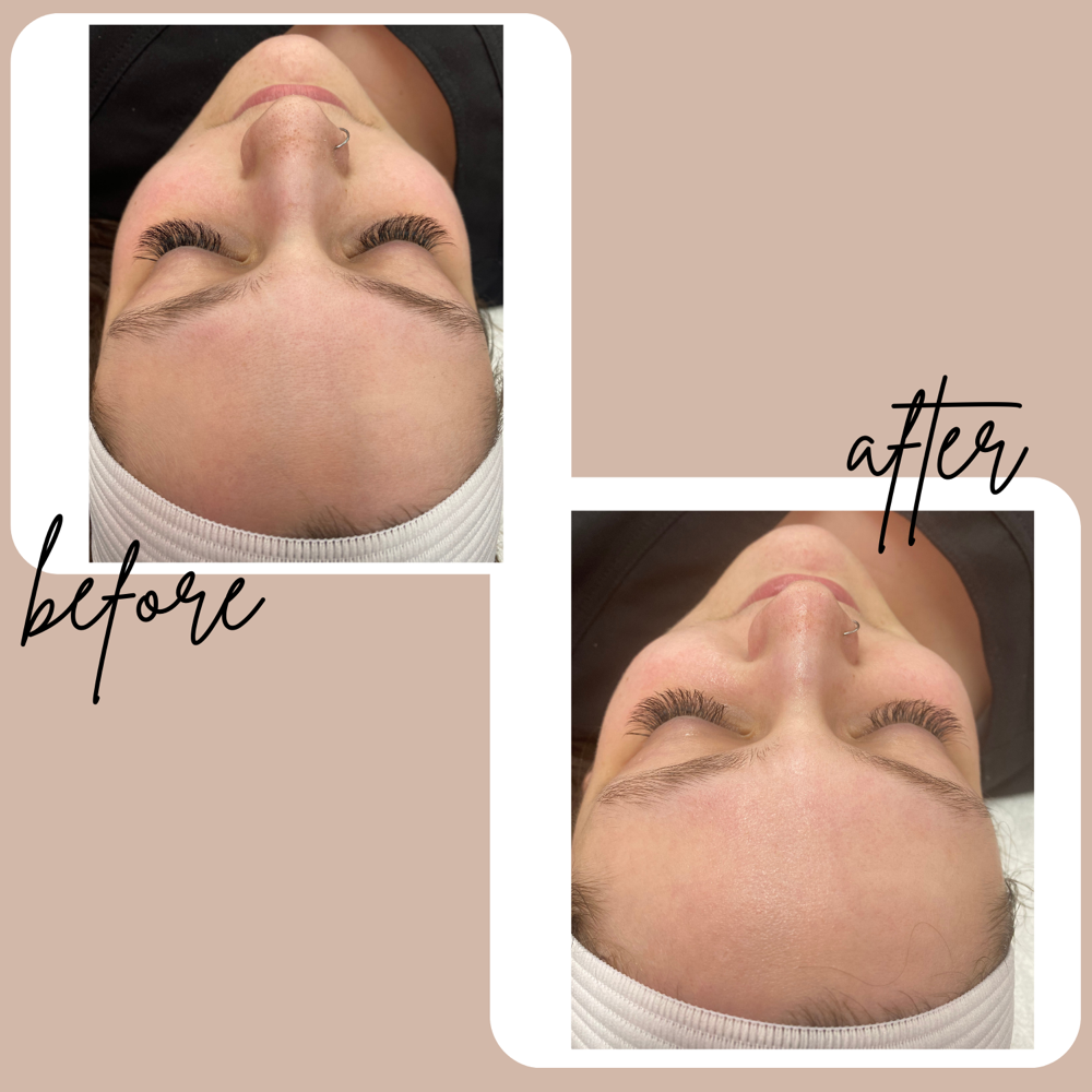 Dermaplaning Facial