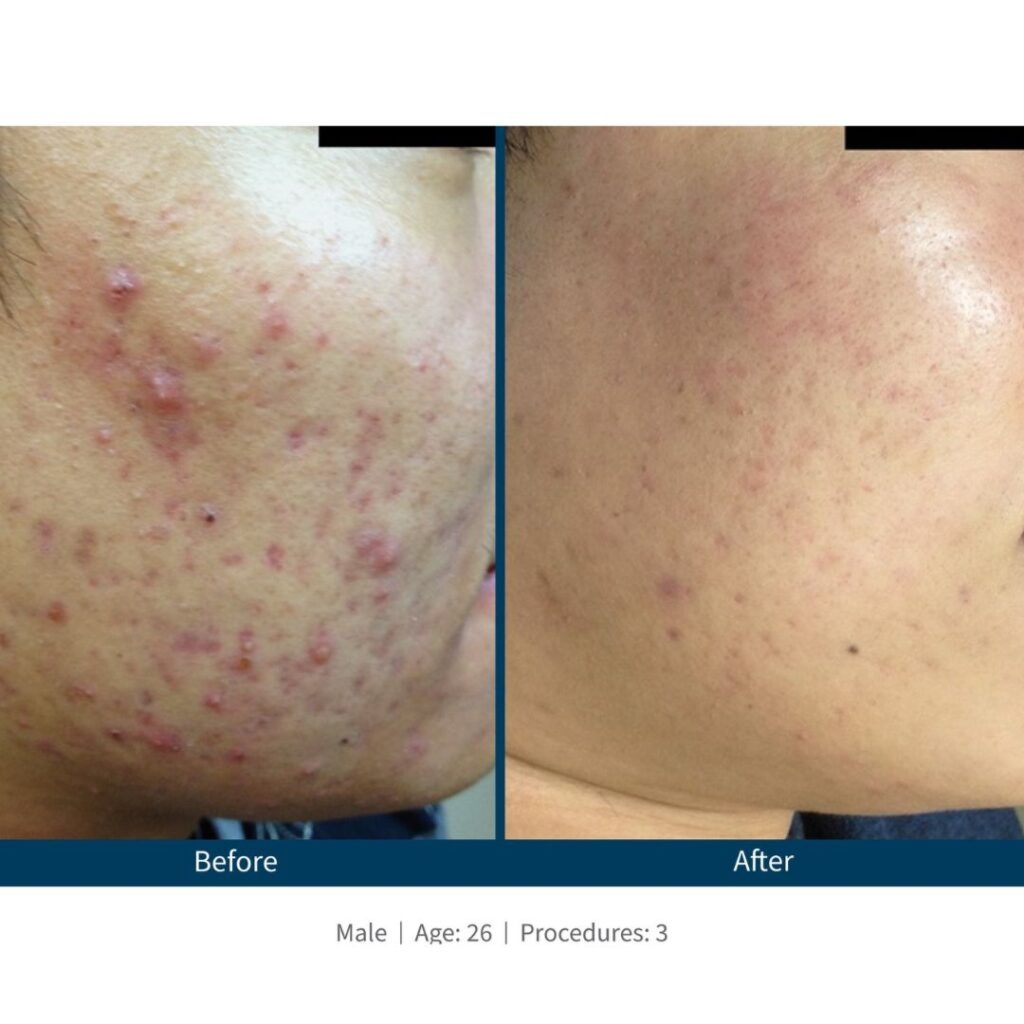 Microchanneling at Lumeva Aesthetic  L.L.C in Maryland, MD