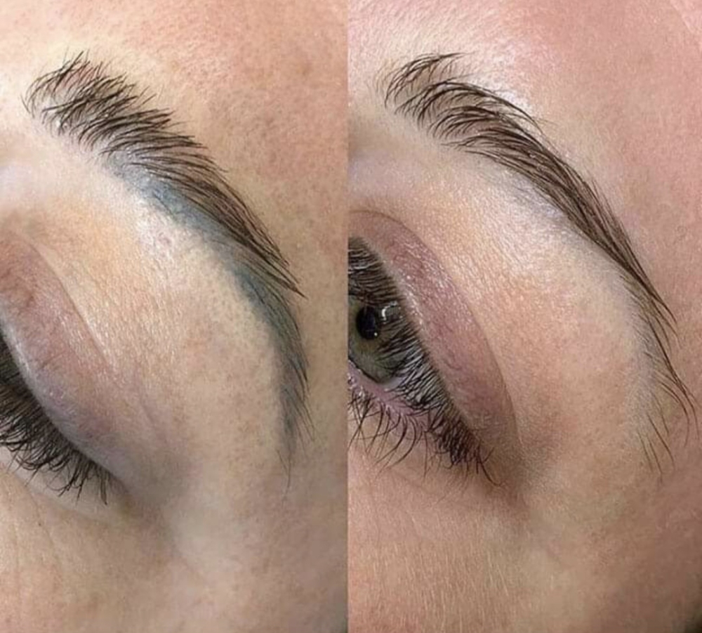 Remoción de Cejas Permanentes