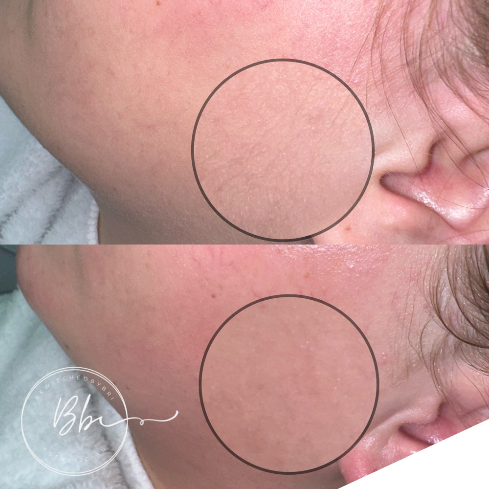Dermaplane Add On